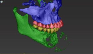 3D digital model of a human skull with colored upper jaw, teeth, and lower jaw.