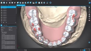 Digital dental model showing lower jaw teeth with red markings on several molars and premolars.