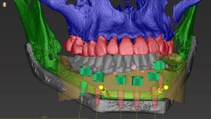 3D dental model showing teeth and jawbone with implants.