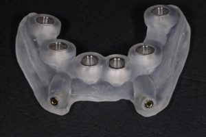 Clear dental surgical guide with metal sleeves for implant placement.