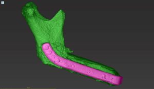 3D model of a jawbone with highlighted mandibular section.